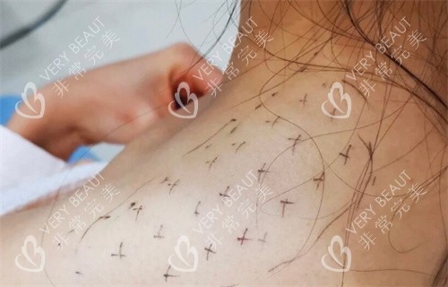 瘦肩注射点位设计图
