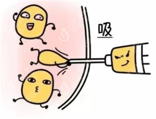 赵军舰吸脂手术动画