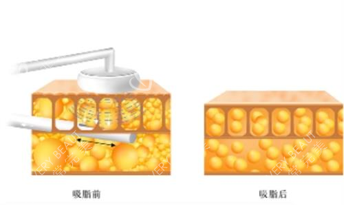 赵军舰吸脂前后对比图