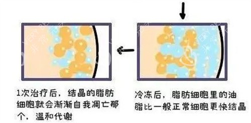 赵军舰吸脂原理