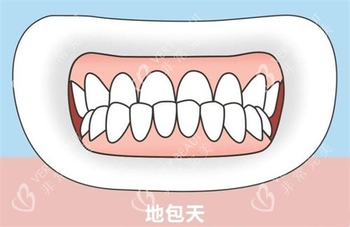 地包天示意图