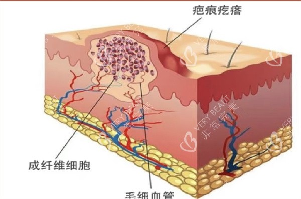 瘢痕