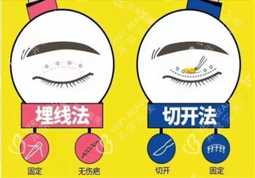 双眼皮埋线和切开对比图