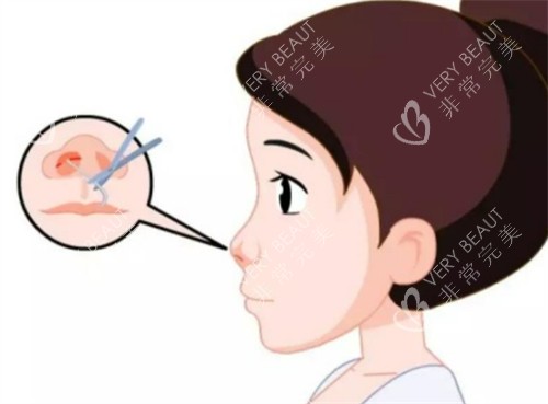 李炳浍隆鼻切口的位置图解