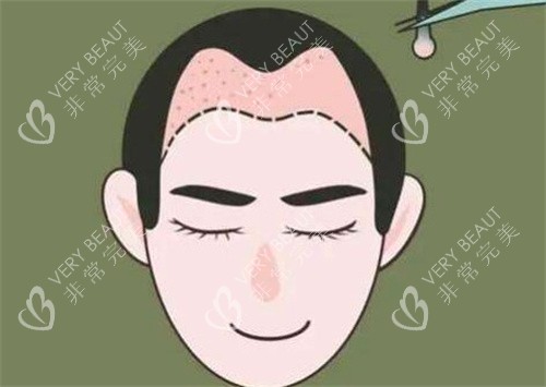 M型发际线种植