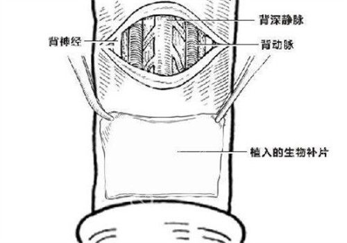 阴茎生物补片创口位置