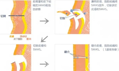 拉皮手术过程