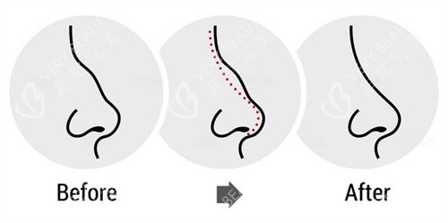 驼峰鼻子的改变过程图