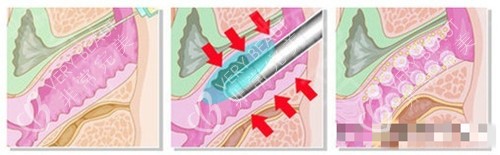 菲蜜丽过程卡通图