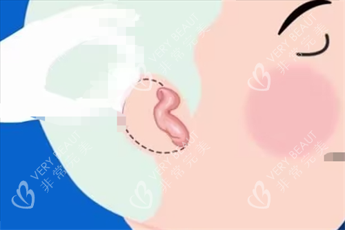 儿童耳再造耳畸形展示