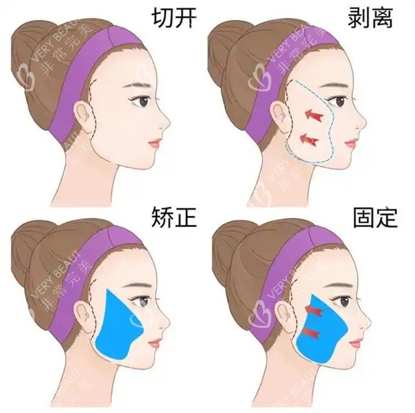 面部拉皮整形手术