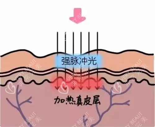 光子嫩肤针对的皮肤层