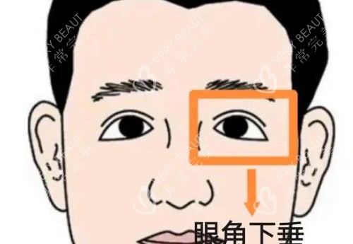 眼角下垂漫画示意图