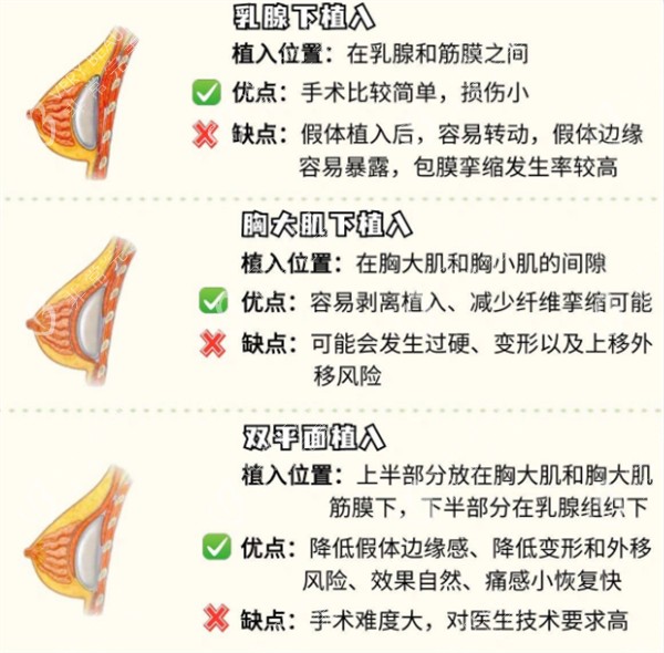 假体隆胸的不同植入位置图解