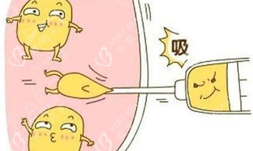 吸脂手术示意图