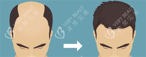 种发际线前后对比