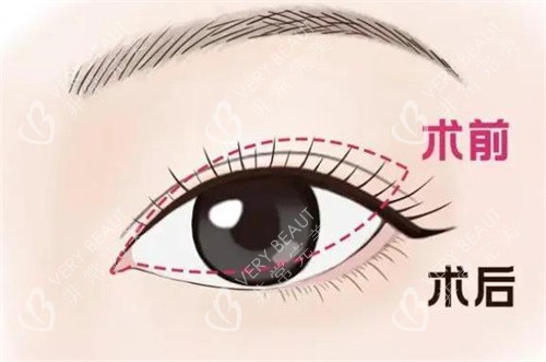 北京丰联丽格双眼皮修复手术对比