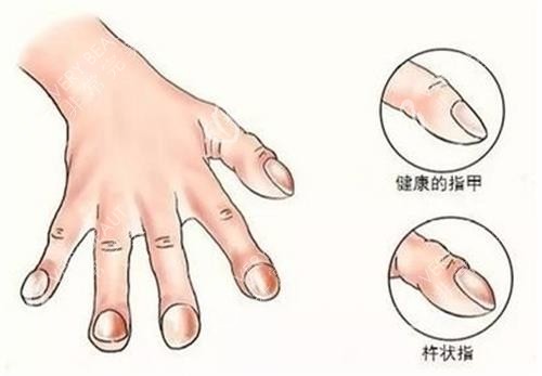 手指畸形的示意图