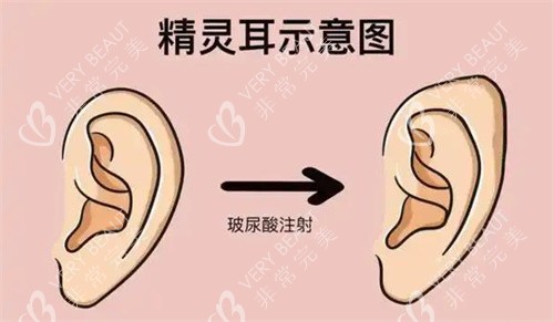 精灵耳注射