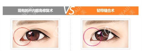 内眼角修复两种手术对比