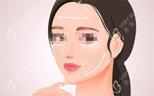 拉皮手术后面部提拉展示图