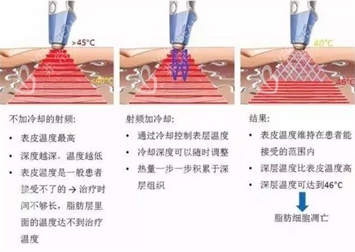 溶脂刀仪器施术过程图解