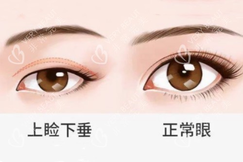 正常眼睛和上睑下垂眼睛对比图
