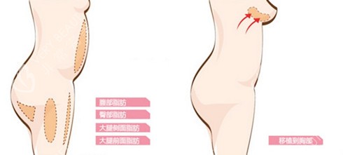 自体脂肪隆胸图