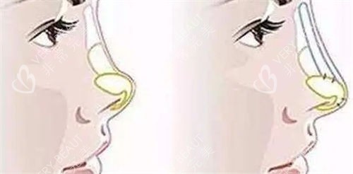 朝天鼻假体填充前后对比图