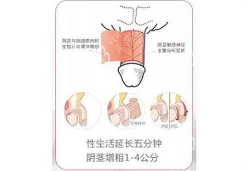 阴茎生物补片手术结果
