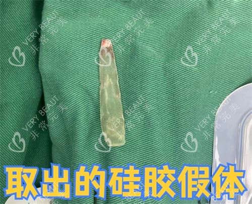 上海王洪医生取出的硅胶假体照片