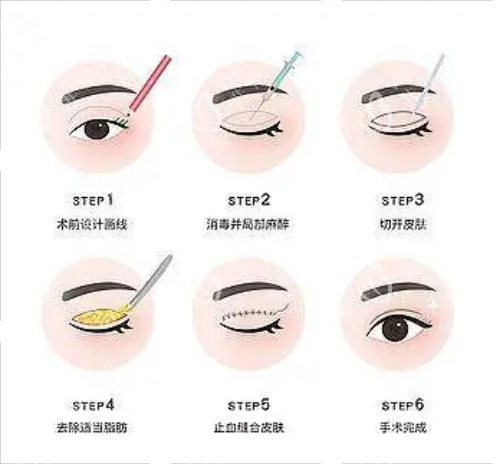 全切双眼皮流程图示
