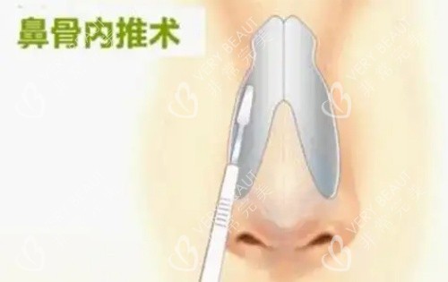 鼻骨内推示意图