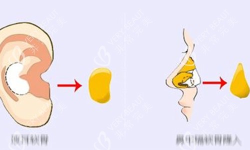 耳软骨隆鼻动画示意图