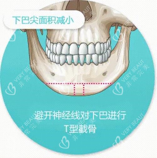 T型截骨术手术切口线演示图
