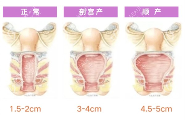 正常阴道和松弛对比照片