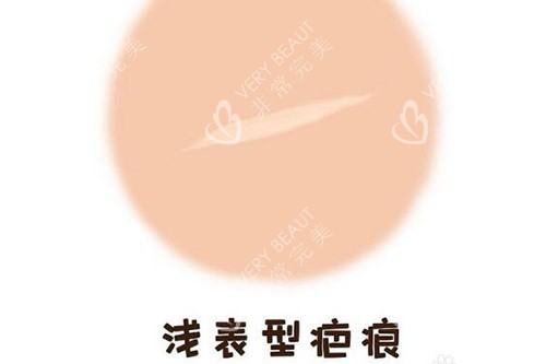 浅表型疤痕修复改善