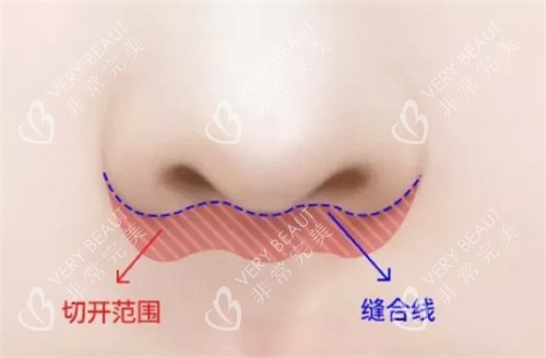 埋线人中缩短术手术位置图解
