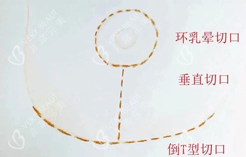 丰胸手术胸部下垂提升倒T字法