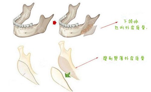 下颌角皮质骨截骨手术图片