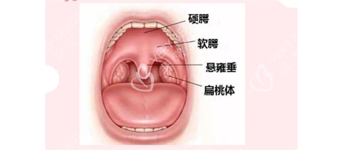 唇腭裂示意图