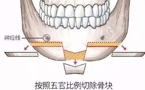 下颏T型截骨示意图