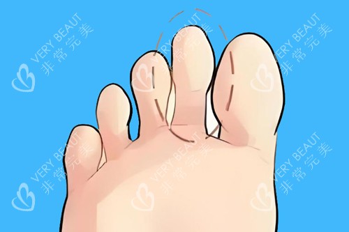 二脚趾长卡通图