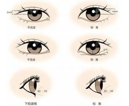双眼皮对比图