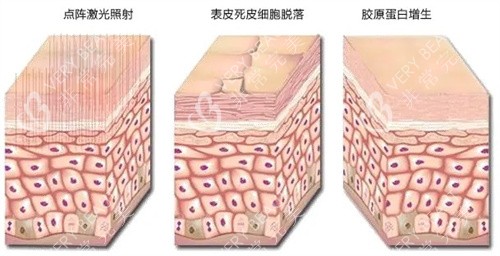 点阵激光过程
