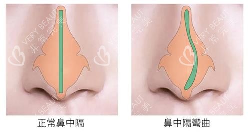 鼻中隔偏曲和正常鼻子的对比