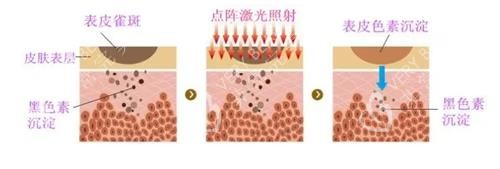 点阵激光的成效