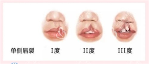 不同的唇腭裂