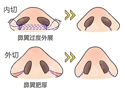 鼻翼缩小内切外切对比