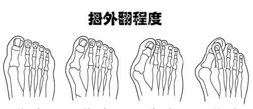 大脚骨外翻程度